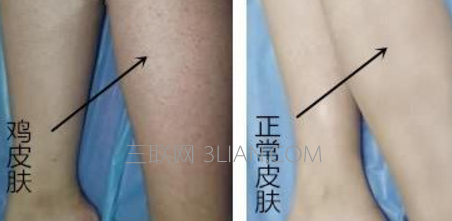 怎样去除鸡皮肤小妙招 114