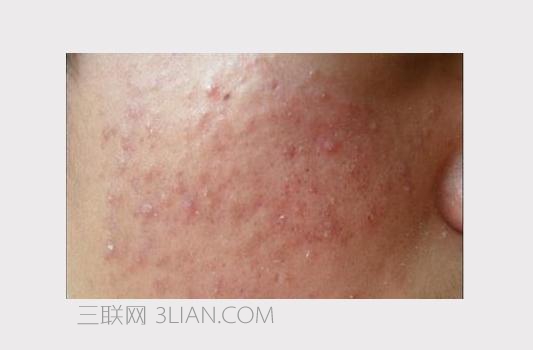 痤疮是什么样子的图片